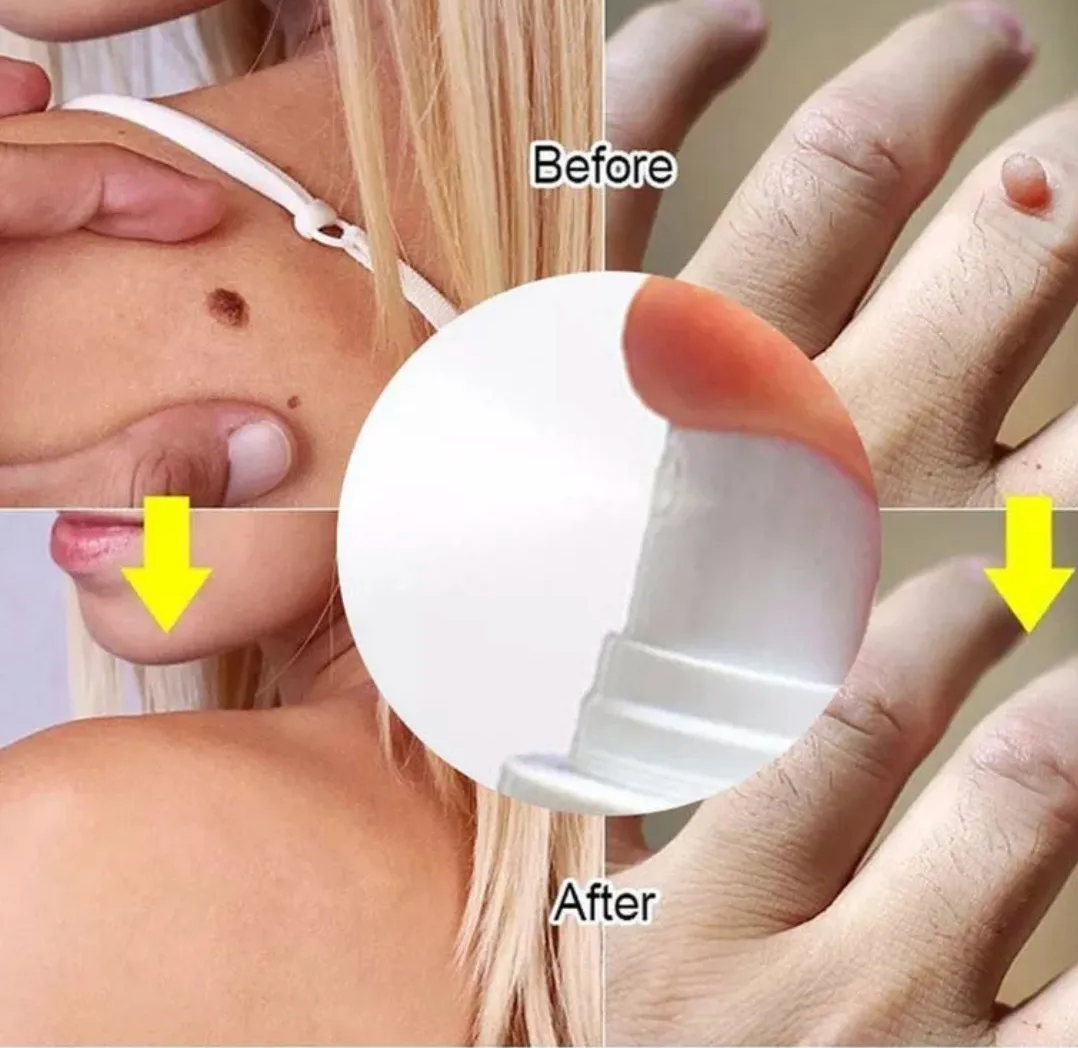 REMOVEDOR DE VERRUGAS WART REMOVER